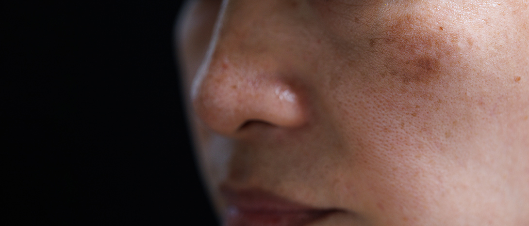 Melasma: o que é, tratamento e tipos